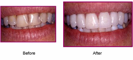 Mouth/teeth before and after dental treatment