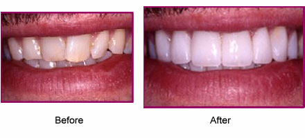 Mouth/teeth before and after dental treatment